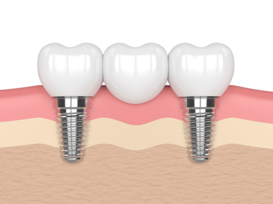 medical implant medical implant